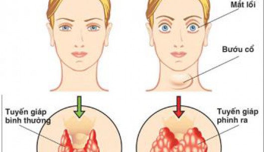 Những hệ lụy do thiếu i-ốt