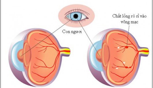 Người tiểu đường có thể bị mù nếu quên khám mắt