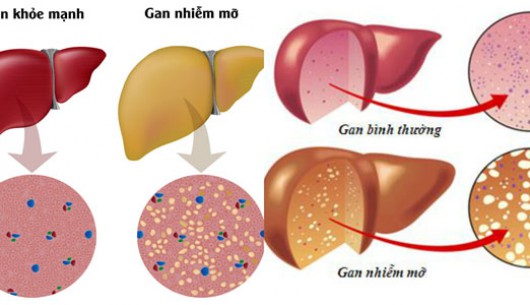 Phòng bệnh gan nhiễm mỡ bắt đầu từ chế độ ăn