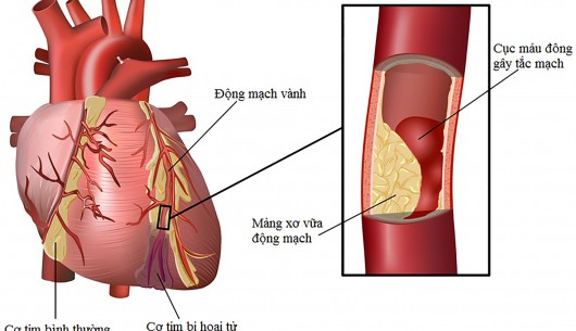 Biến chứng về tim mạch ở bệnh nhân đái tháo đường – làm thế nào để phòng ngừa???