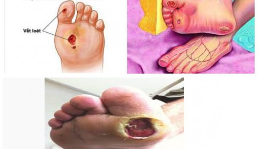 Chăm sóc bàn chân ở người bệnh đái tháo đường