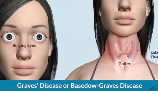 Tại sao bệnh Basedow lại gây lồi mắt