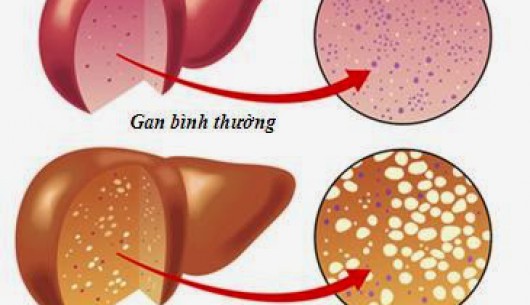 Mách bạn các dấu hiệu khi gan bị nhiễm mỡ