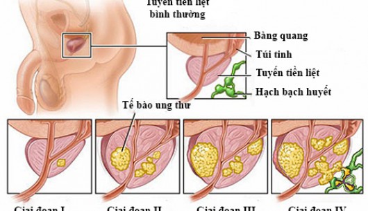 Các giai đoạn của bệnh ung thư tiền liệt tuyến