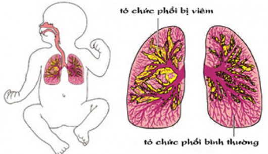 Viêm phổi bệnh gây tử vong cao ở trẻ