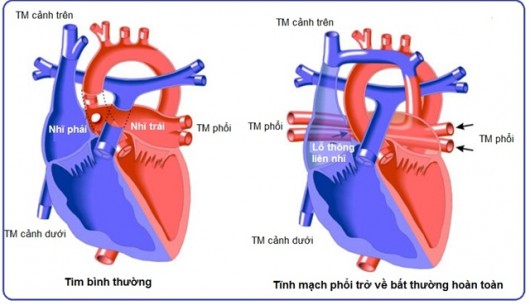 Cứu sống bé trai 2 tháng tuổi dị tật tim bẩm sinh phức tạp