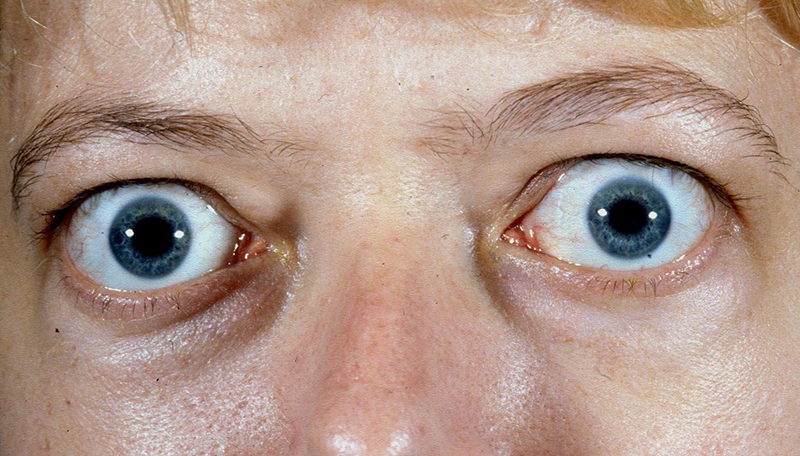Bệnh basedow và triệu chứng lòi mắt điển hình 